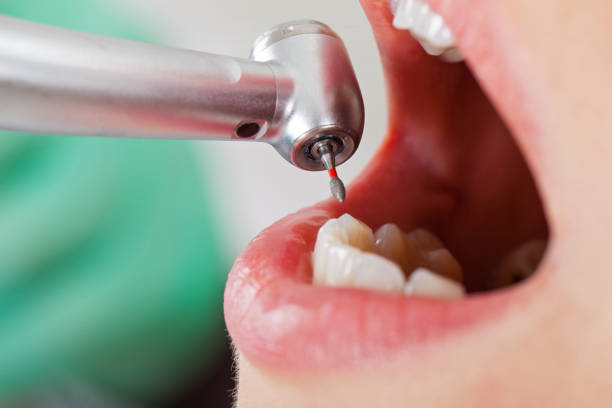 Best Emergency Broken Tooth Repair in Floris, VA